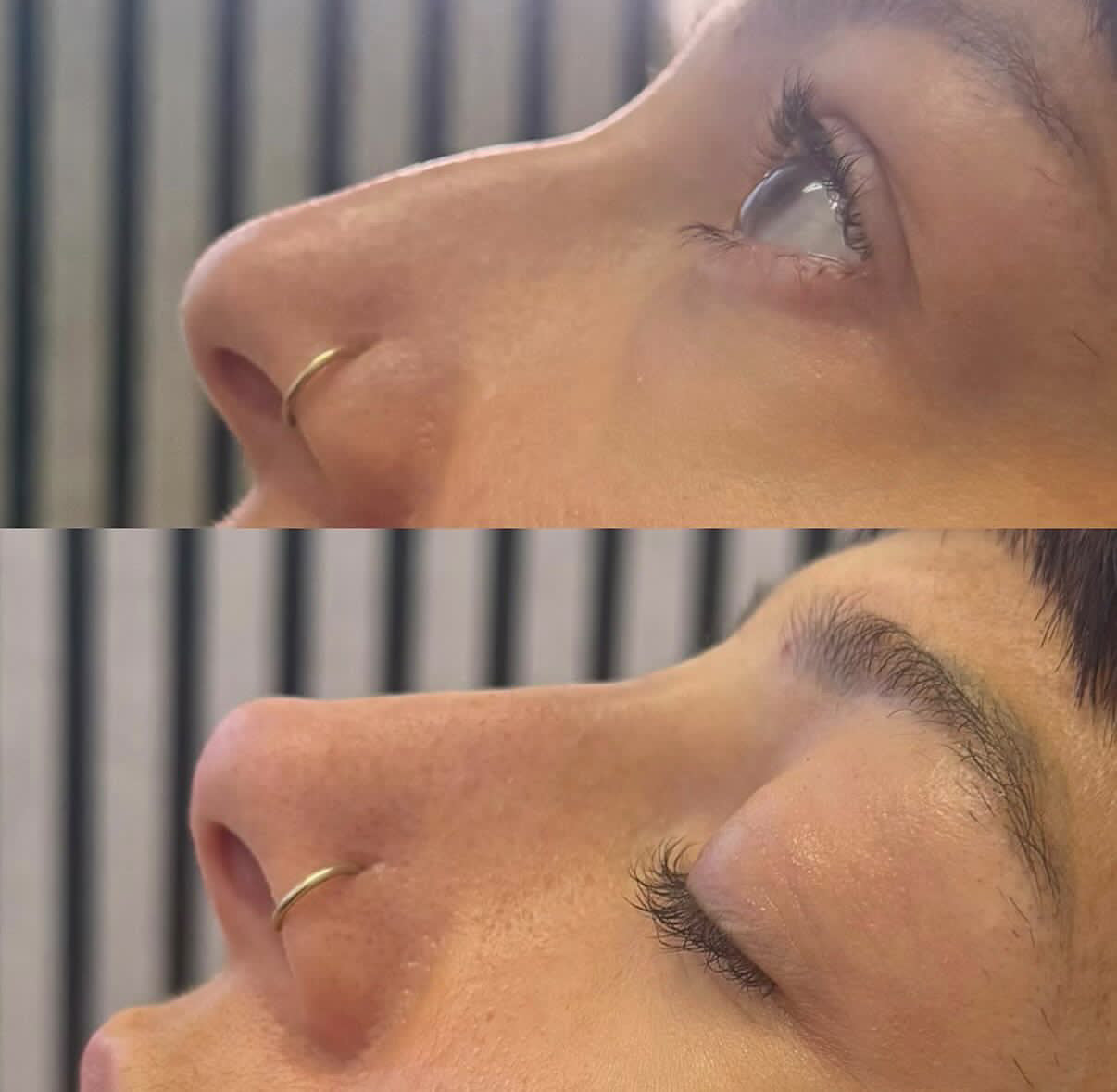 Non Surgical Rhinoplasty
