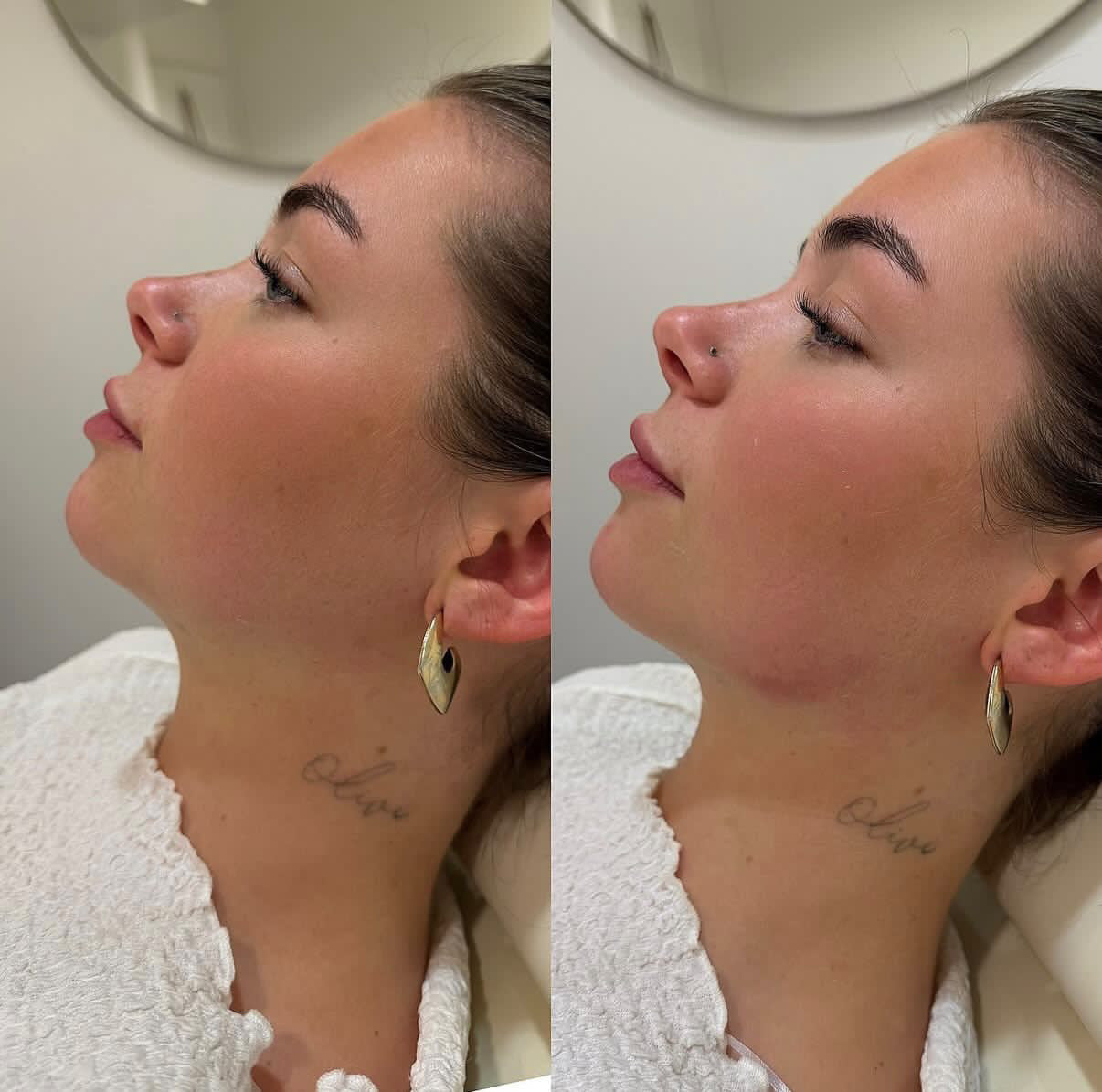 Dermal Fillers Jaw