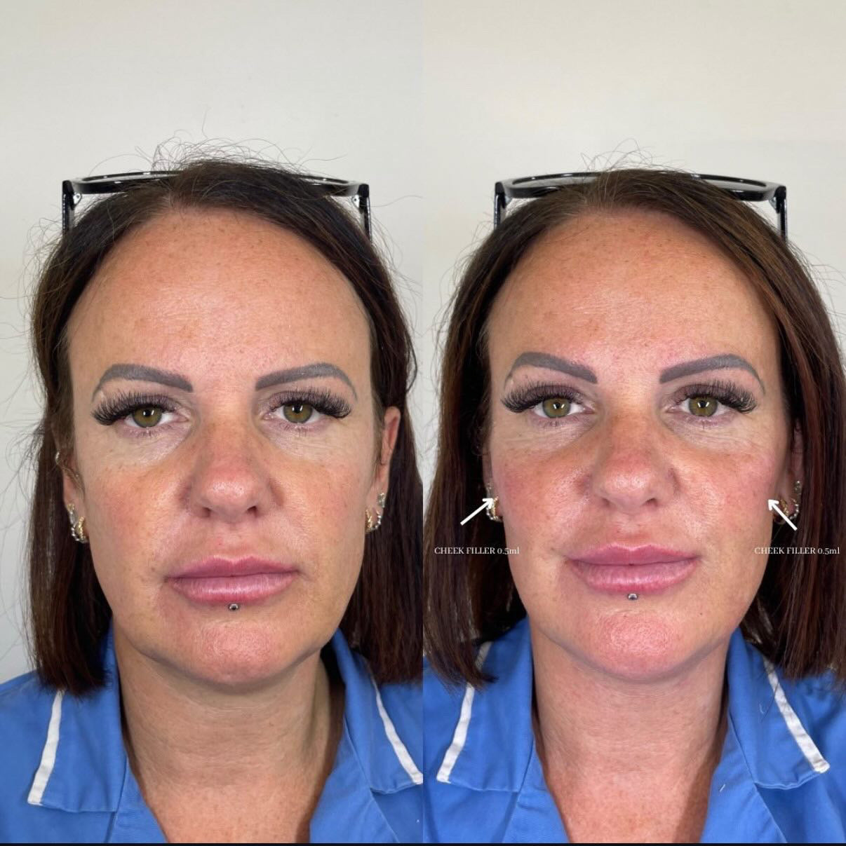 Dermal Filler Cheeks