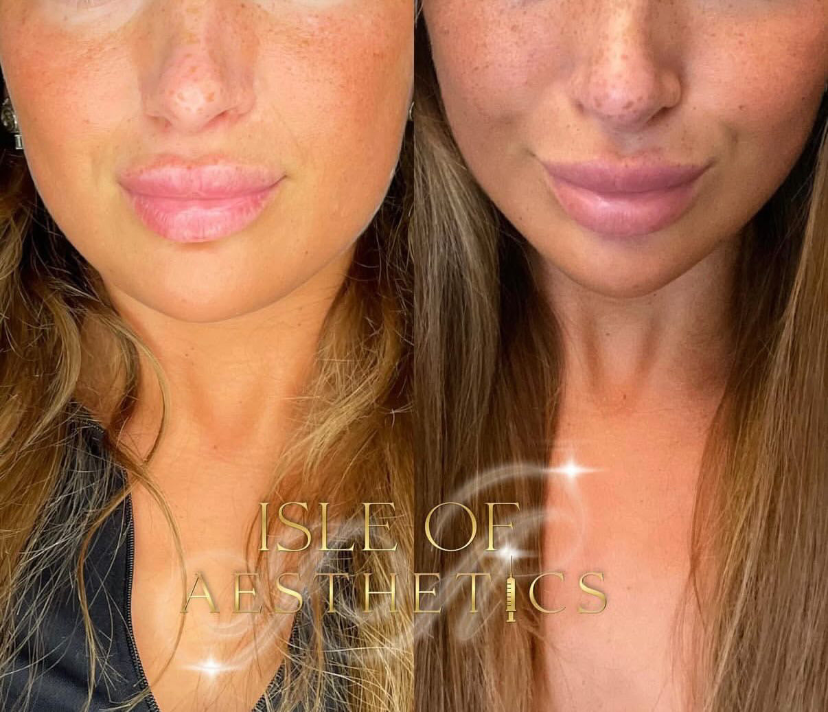 Anti Wrinkle Masseter/Jaw