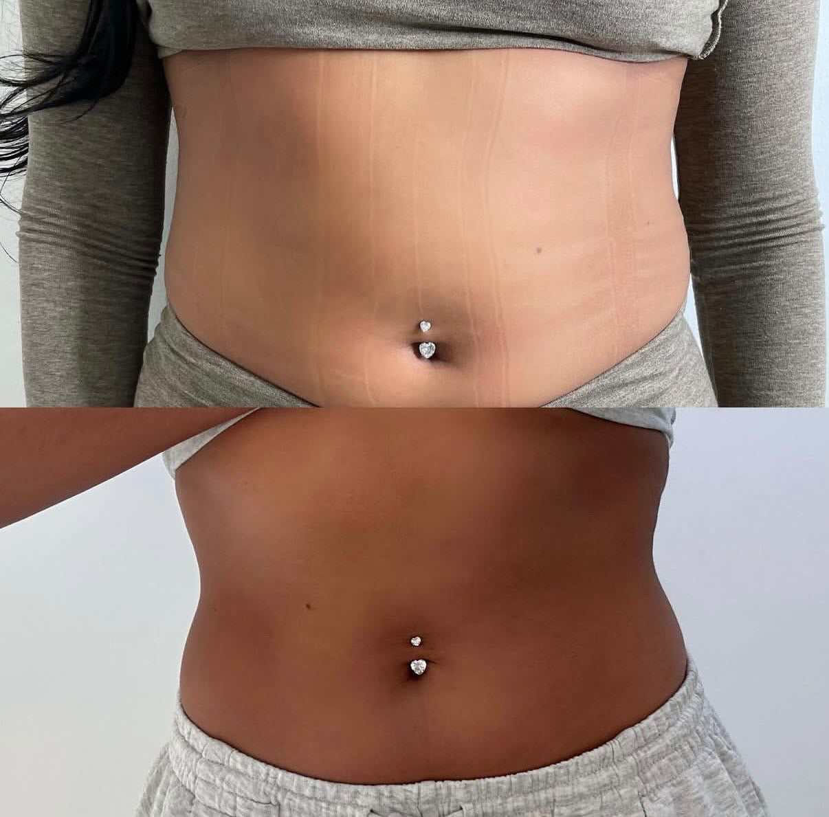 Large Area Fat Dissolving