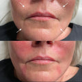 Dermal Filler Nasolabials