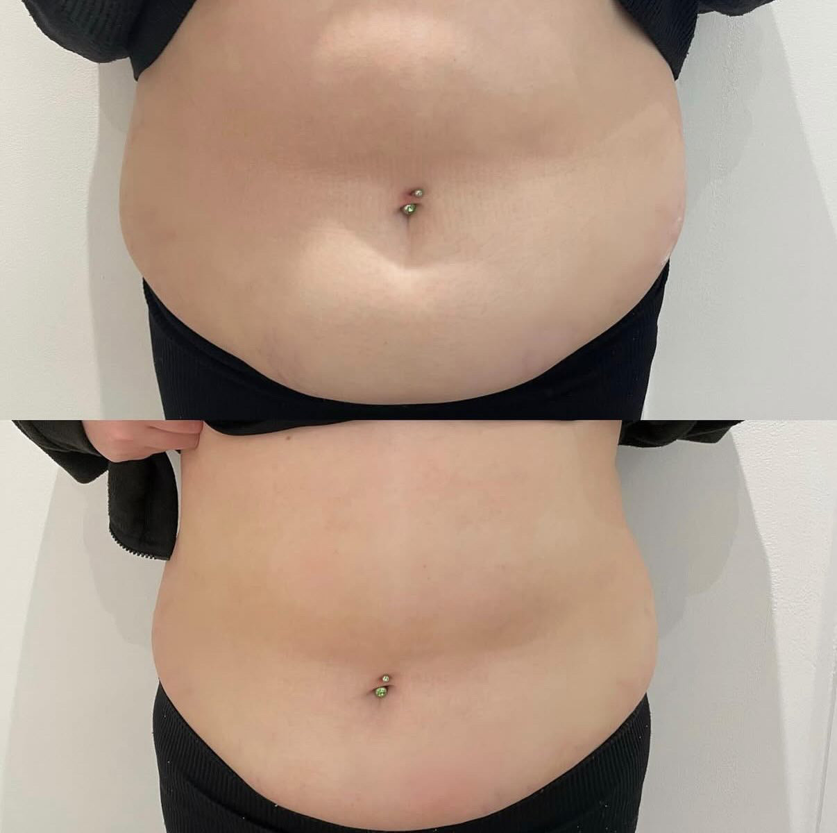 Large Area Fat Dissolving