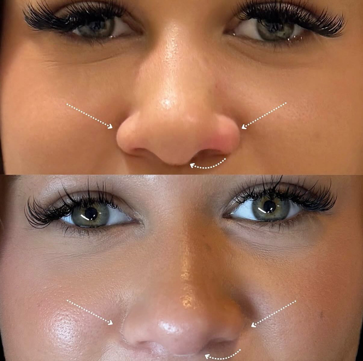 Anti Wrinkle Nose Slimming Procedure