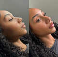 Dermal Fillers Chin