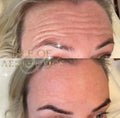 Anti Wrinkle Areas
