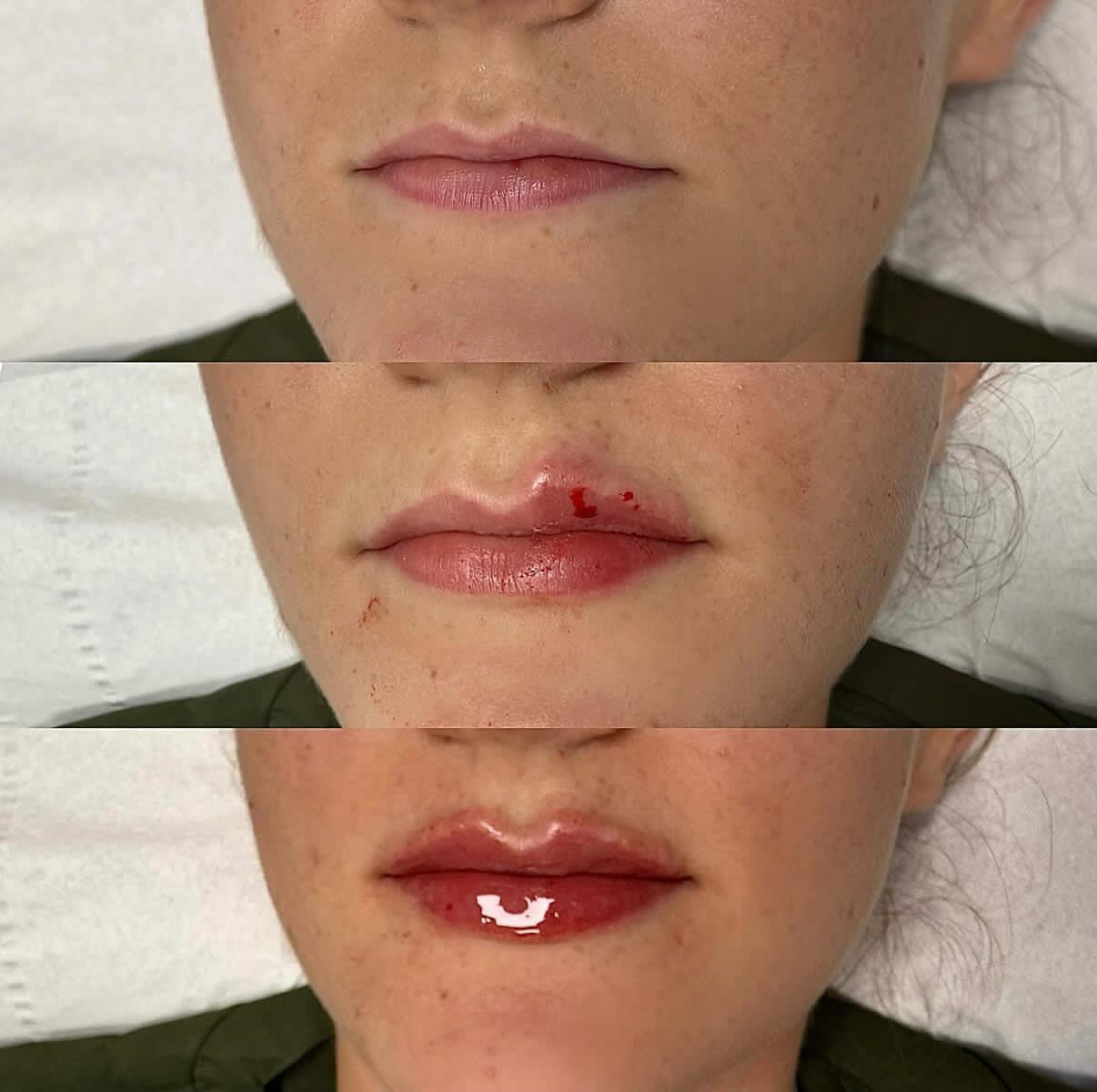 Lip Filler